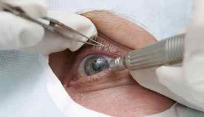 Заміна кришталика ока: операція, ціни, відгуки, при катаракті