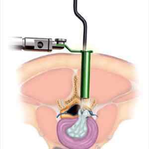 Заміна міжхребцевого диска: протезування суглобів, операція по заміні, лазерна реконструкція, відгуки | Ревматолог