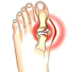 Запалення кісточки на великому пальці ноги: лікування кісткової тканини і що робити | Ревматолог