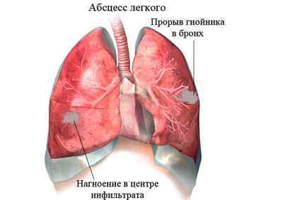 Запалення легенів (пневмонія) у дітей: лікування по Комаровскому