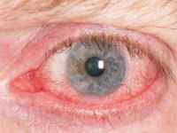 Запалення очі: лікування почервоніння, ніж лікувати запальні захворювання в домашніх умовах