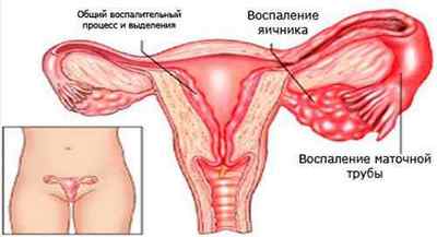 Запалення придатків при вагітності: лікування, симптоми