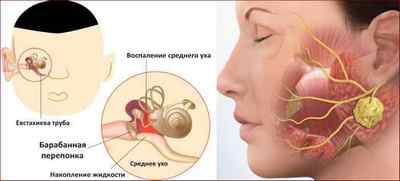 Запалення середнього вуха: причини, симптоми і лікування