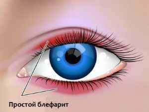 Запалення століття очі (верхнього або нижнього): чим лікувати, якщо запалилося, методи лікування