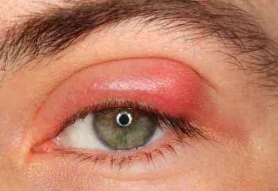 Запалення століття очі (верхнього або нижнього): чим лікувати, якщо запалилося, методи лікування