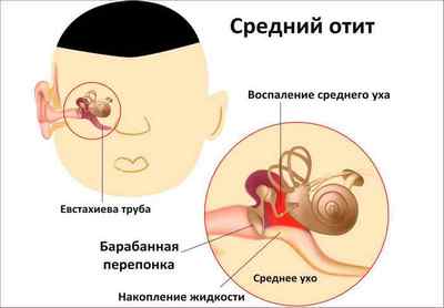 Запалення внутрішнього вуха (внутрішній отит): симптоми, лікування