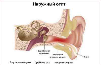 Запалення вуха: причини, симптоми і лікування