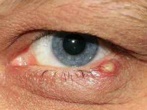 Заразний ячмінь на оці для оточуючих чи ні, ймовірність зараження