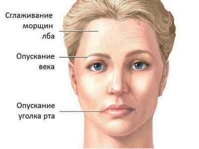 Защемлення лицьового нерва: симптоми і лікування