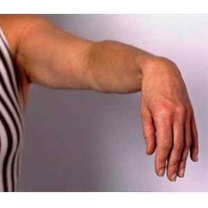 Защемлення променевого нерва в руці: симптоми і лікування, що робити якщо защемило | Ревматолог