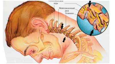 Защемлення шийного хребця: симптоми і чим лікувати утиск нерва в шийному відділі, шийний остеохондроз і невралгія | Ревматолог