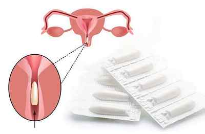 Застосування вагінальних свічок при ерозії шийки матки: препарати, схеми прийому