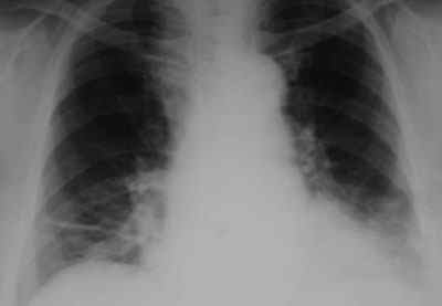 Застійні явища в легенях: що це таке, симптоми, лікування