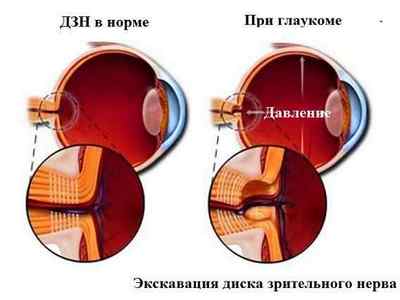 Застійний диск зорового нерва, лікування екскавації, застою і гіпоплазії