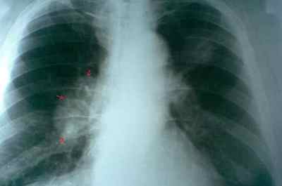 Затемнення в легенях на рентгені - що це може бути
