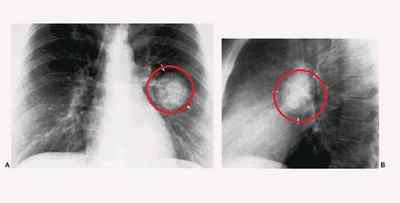 Затемнення в легенях на рентгені - що це може бути
