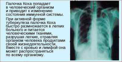 Збудник туберкульозу легенів - що викликає захворювання