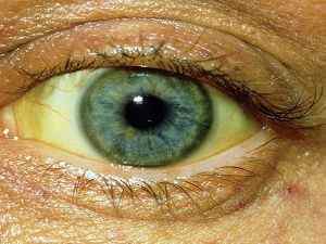 Желтушность склер: причини жовтих очей, як очистити від жовтизни у новонароджених