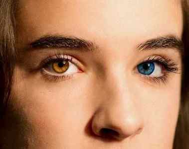 Жовті очі: причини і лікування білків очей, симптоми пожовтіння склер у людини