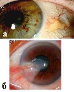 Жовті очі: причини і лікування білків очей, симптоми пожовтіння склер у людини