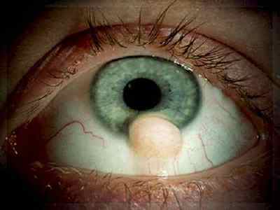 Жовта пляма на білку ока біля зіниці, причини появи на очному яблуці