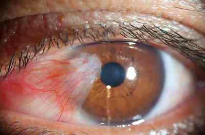 Жовта пляма на білку ока біля зіниці, причини появи на очному яблуці