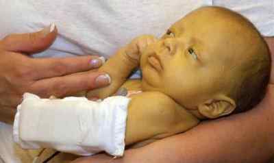 Жовтяниця новонароджених: причини, методи лікування