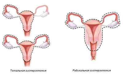 Злоякісні пухлини жіночих статевих органів: аденокарциноми матки, і інші освіти