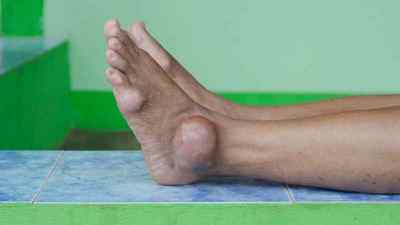 Знеболюючі при подагрі: таблетки при подагрі на ногах, Кеторол, як знеболити, ефективні мазі і ліки в домашніх умовах | Ревматолог