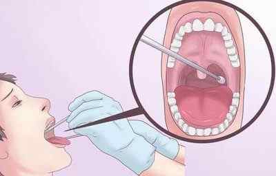 Золотистий стафілокок в горлі: симптоми, лікування