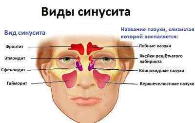 Золотистий стафілокок в носі і в горлі: симптоми, лікування