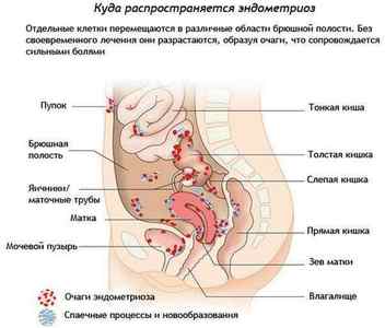 Зовнішній генітальний ендометріоз: що це таке, симптоми і лікування