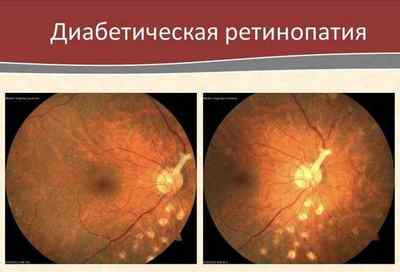 Зір при цукровому діабеті: як захворювання впливає на очі, діагностика патологій