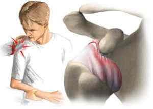 Звичний вивих плеча - причини, симптоми і лікування