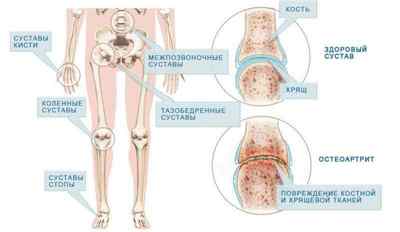 Звуження суглобових щілин: лікування звуження суглобової щілини колінного суглоба, розмір суглобової щілини в нормі, нерівномірно звужена | Ревматолог