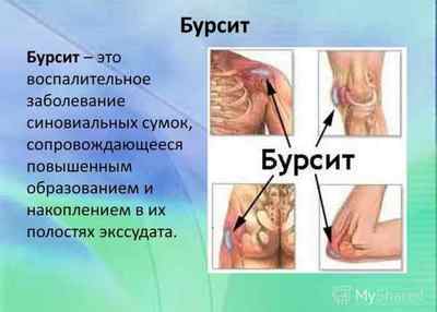 Звязок артрозу, артриту і гормонального фону