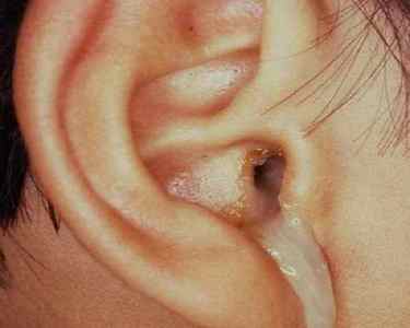 Зясовуємо симптоми і лікування отиту середнього вуха у дітей